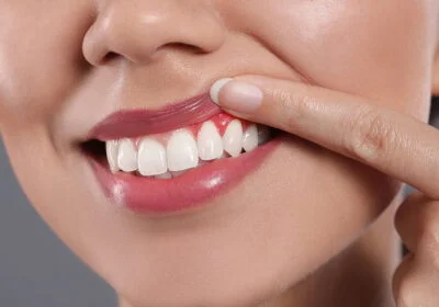 Diş eti kanaması: Ağız hijyeni eksikliği veya diş eti hastalıklarının belirtisi olabilir.